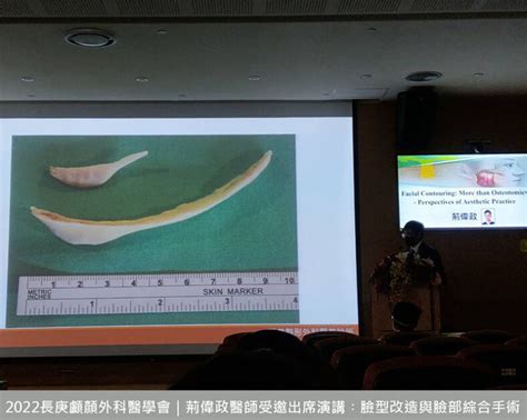 頭型兩側有角|台灣顱顏學會 衛教資訊 頭型、臉型與顱顏手術